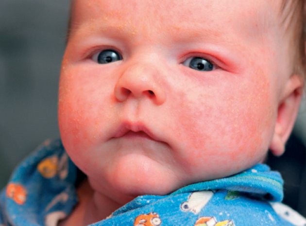 Health Concerns Atopic Eczema A Unique Child Teach Early Years
