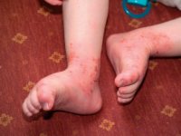 Health Concerns: Atopic Eczema