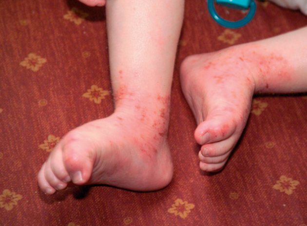 Health Concerns: Atopic Eczema