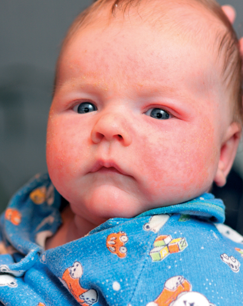 Health Concerns: Atopic Eczema