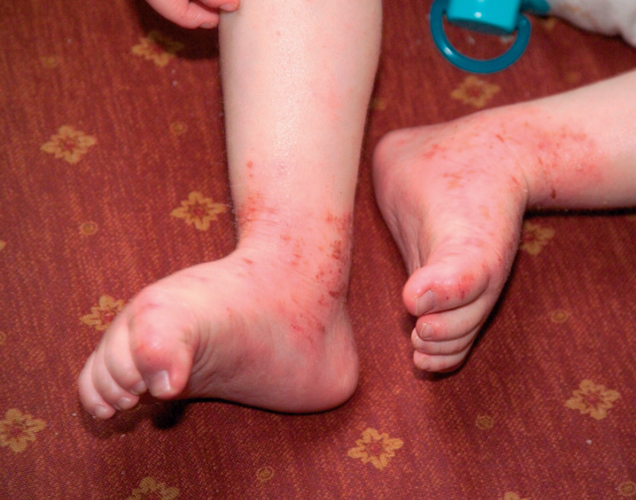 Health Concerns Atopic Eczema A Unique Child Teach Early Years Health Concerns Atopic Eczema A Unique Child Teach Early Years